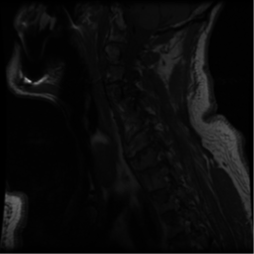 File:Cervical canal stenosis with cord compression (Radiopaedia 34114-35374 Sagittal T1 10).png