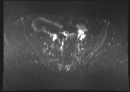 File:Cervical carcinoma (Radiopaedia 88312-104943 Axial DWI 8).jpg