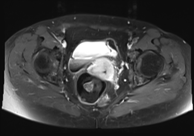 File:Cervical carcinoma (Radiopaedia 88312-104943 Axial T1 C+ fat sat 14).jpg