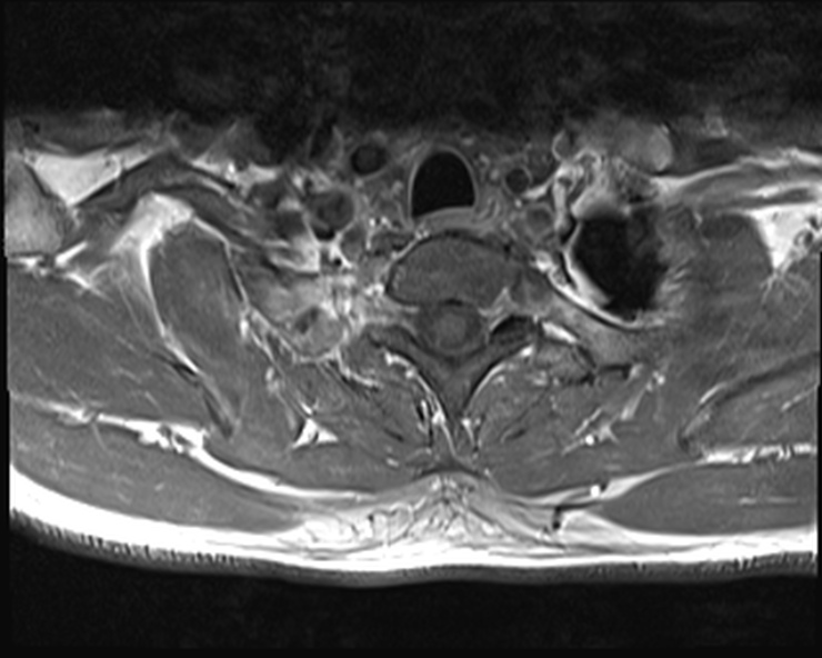 File:Cervical disc extrusion (Radiopaedia 53950-60077 Axial T1 C+ fat sat 29).jpg