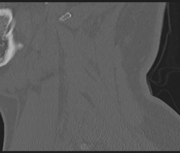 Cervical disc replacement (Radiopaedia 44025-47541 Sagittal bone window 16).png