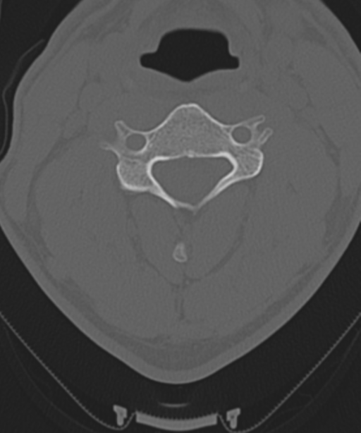Cervical intercalary bone (Radiopaedia 35211-36748 Axial bone window 31).png