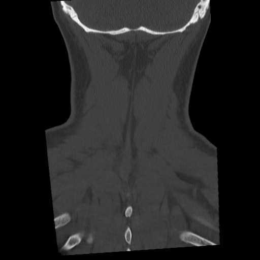 Cervical schwannoma (Radiopaedia 57979-64974 Coronal bone window 50).png