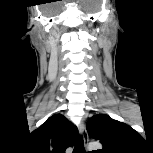 Cervical schwannoma (Radiopaedia 57979-64974 G 30).png