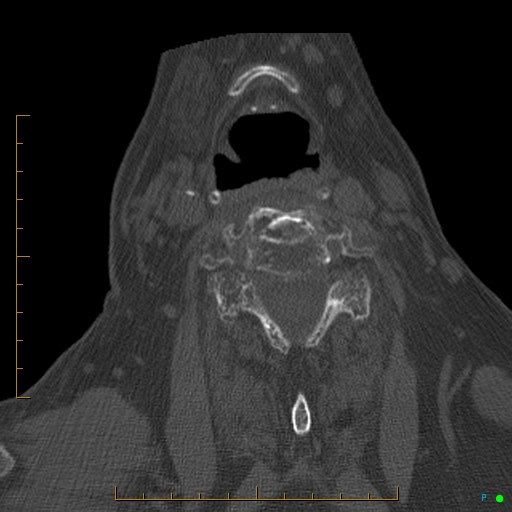 Cervical spine fracture - ankylosing spondylitis (Radiopaedia 76835-88706 Axial bone window 133).jpg