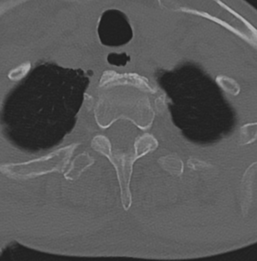 Cervical spondylolysis (Radiopaedia 49616-54811 Axial bone window 51).png