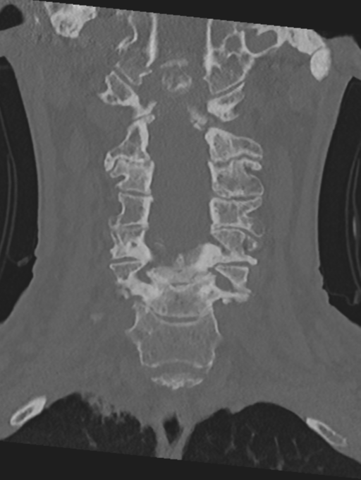 Cervical spondylolysis (Radiopaedia 49616-54811 Coronal bone window 22).png