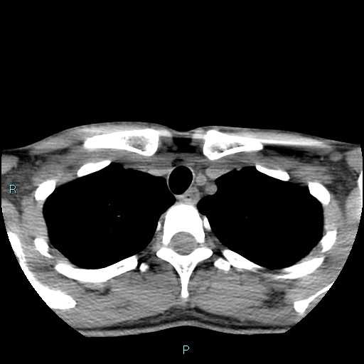 Cervical thymic cyst (Radiopaedia 88632-105335 Axial non-contrast 21).jpg