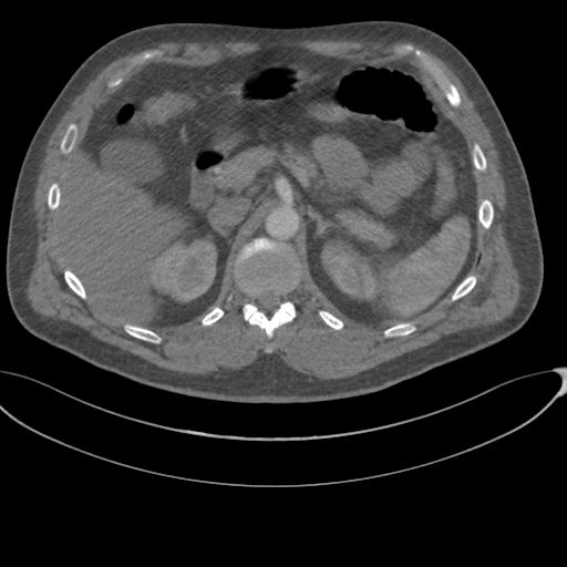 File:Chest multitrauma - aortic injury (Radiopaedia 34708-36147 A 311).png