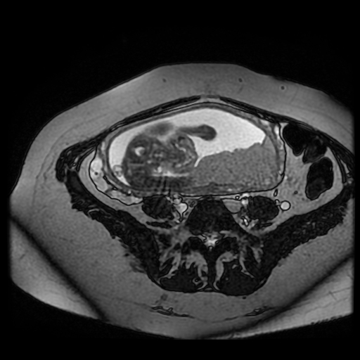 Chiari II malformation - fetal MRI (Radiopaedia 68099-77581 Axial Fiesta 29).jpg