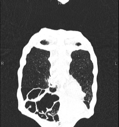 Chilaiditi sign (Radiopaedia 88839-105611 Coronal lung window 8).jpg