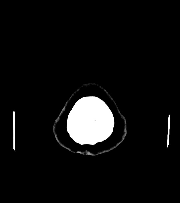 Cholangiocarcinoma with cerebral metastases (Radiopaedia 83519-98628 Axial non-contrast 63).jpg