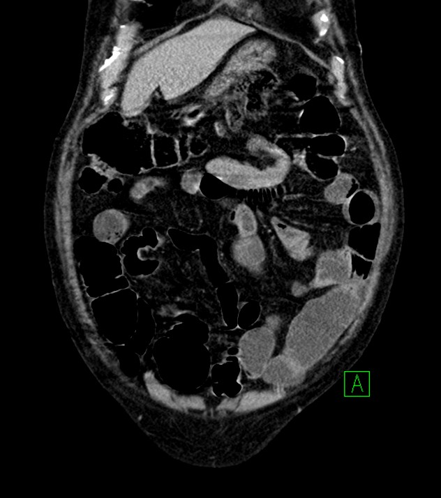 Cholangiocarcinoma with cerebral metastases (Radiopaedia 83519-98629 G 16).jpg