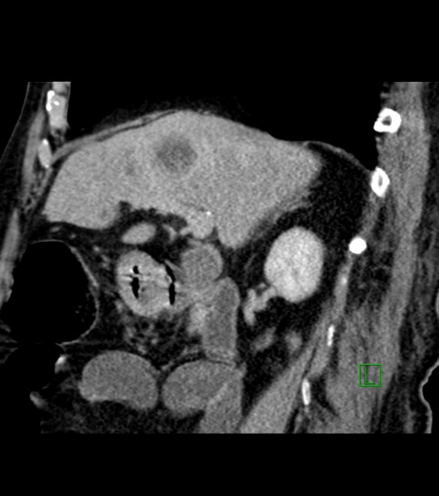 Cholangiocarcinoma with cerebral metastases (Radiopaedia 83519-98629 Sagittal C+ delayed 71).jpg
