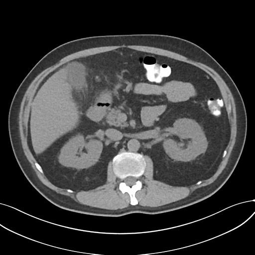 File:Cholecystitis with focal perforation and hepatic abscess (Radiopaedia 37189-38945 Axial non-contrast 32).png