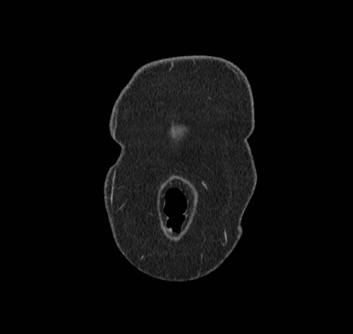 Cholecystoduodenal fistula (Radiopaedia 48959-54022 B 1).jpg