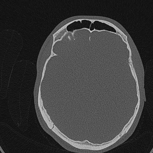 Cholesteatoma (Radiopaedia 70429-80529 Axial bone window 135).jpg