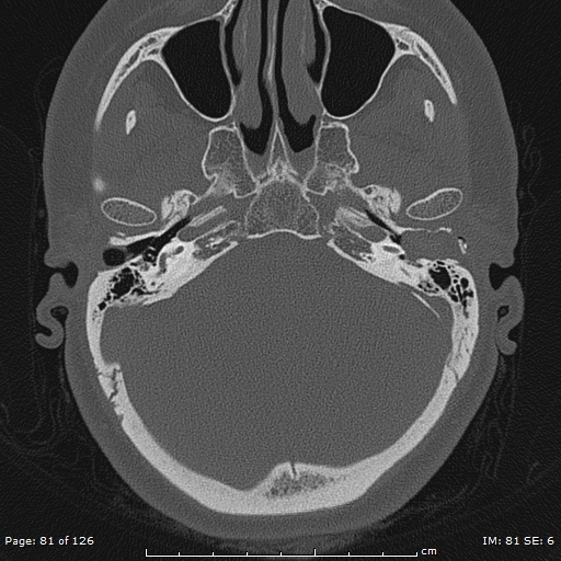 Cholesteatoma - external auditory canal (Radiopaedia 88452-105096 Axial bone window 44).jpg