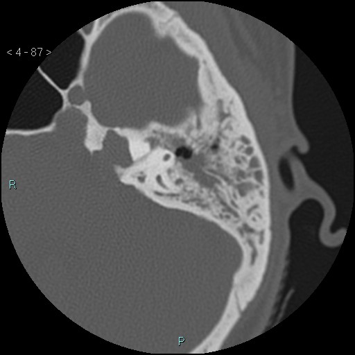 File:Cholesterol granuloma of the petrous apex (Radiopaedia 64358-73141 Axial bone window 42).jpg