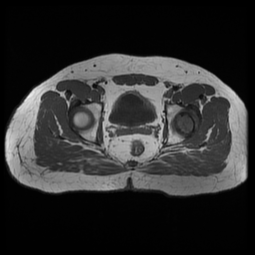 File:Chondroblastoma (Radiopaedia 12264-12564 Axial T1 7).jpg