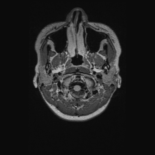 Chondrosarcoma (Radiopaedia 41937-44939 Axial FLAIR 5).png