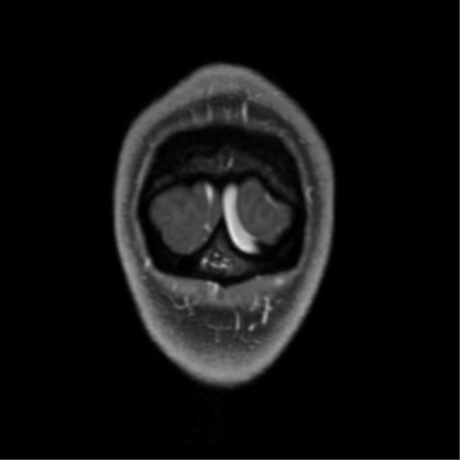 Chondrosarcoma (Radiopaedia 41937-44939 Coronal T1 C+ 15).png