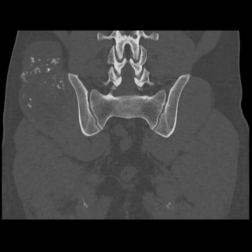 Chondrosarcoma of iliac wing (Radiopaedia 63861-72599 Coronal bone window 81).jpg