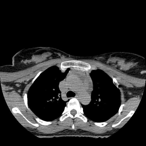 File:Choriocarcinoma of ovary with cerebral and pulmonary metastases (Radiopaedia 25983-26119 Axial non-contrast 111).jpg