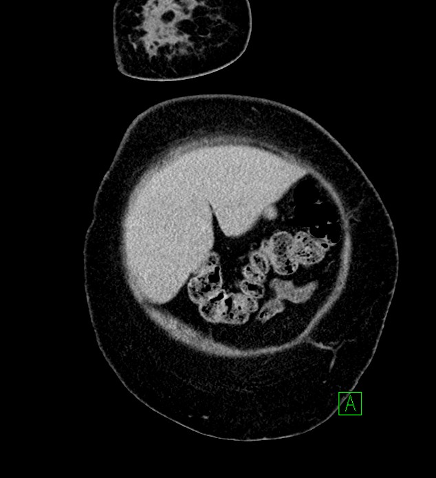 Chromophobe renal cell carcinoma (Radiopaedia 84239-99519 F 11).jpg