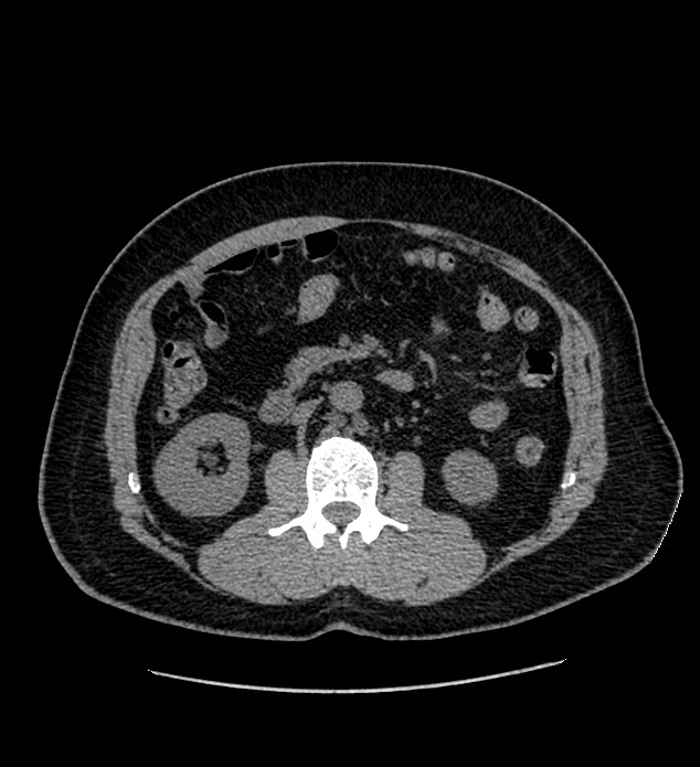 Chromophobe renal cell carcinoma (Radiopaedia 84337-99693 Axial non-contrast 61).jpg