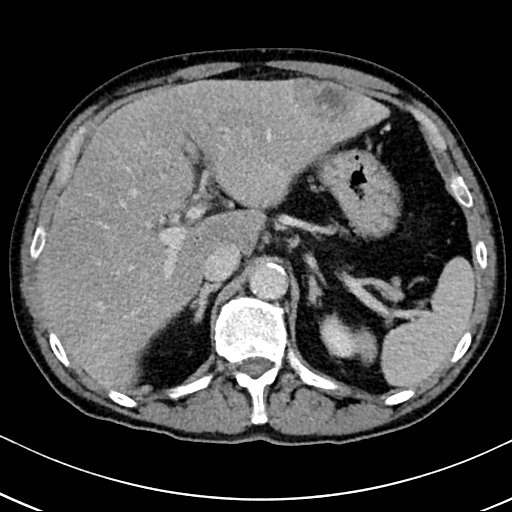 Chronic appendicitis complicated by appendicular abscess, pylephlebitis and liver abscess (Radiopaedia 54483-60700 B 45).jpg