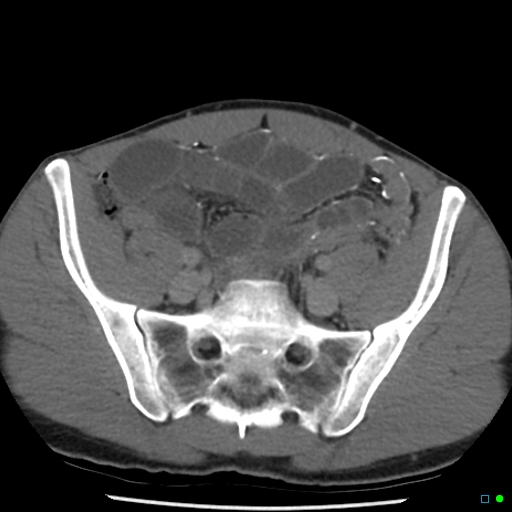 File:Chronic barium peritonitis and small bowel obstruction (Radiopaedia 29151-29548 D 12).jpg