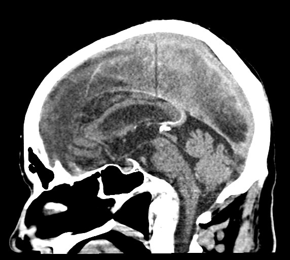 Chronic bilateral subdural hygroma (Radiopaedia 85801-101623 C 33).jpg