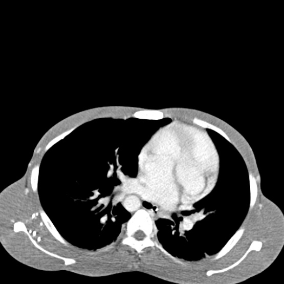 File:Chronic large bowel pseudo-obstruction (Radiopaedia 43181-46492 A 13).jpg