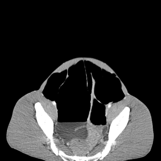 Chronic large bowel pseudo-obstruction (Radiopaedia 43181-46492 A 143).jpg