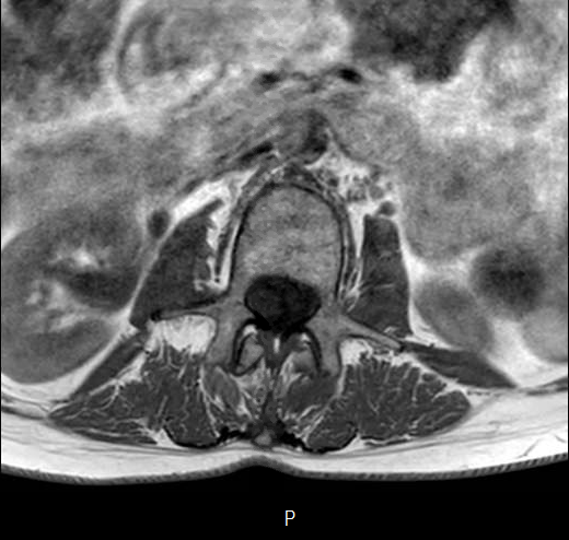 File:Chronic spinal hematoma with cauda equina syndrome (Radiopaedia 75745-87090 Axial T1 10).png