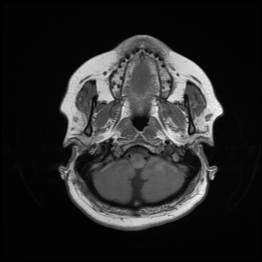 File:Chronic submandibular sialadenitis (Radiopaedia 61852-69885 Axial T1 5).jpg