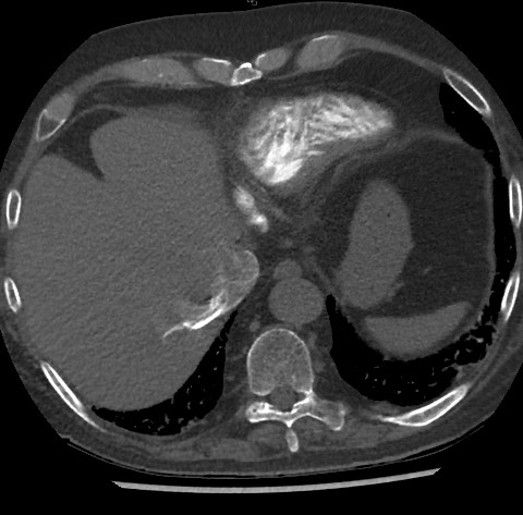 Chronic thromboembolic pulmonary disease (Radiopaedia 90694-108119 Axial C+ CTPA 81).jpg