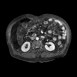 Cirrhosis and hepatocellular carcinoma in the setting of hemochromatosis (Radiopaedia 75394-86594 Axial T1 C+ fat sat 189).jpg