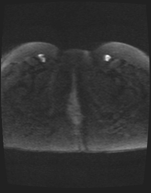 Class II Mullerian duct anomaly- unicornuate uterus with rudimentary horn and non-communicating cavity (Radiopaedia 39441-41755 Axial DWI 62).jpg