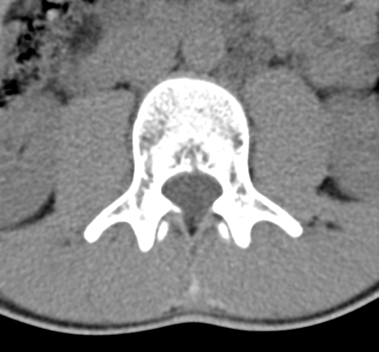 Clear cell meningoma - lumbar spine (Radiopaedia 60116-67691 Axial non-contrast 26).png
