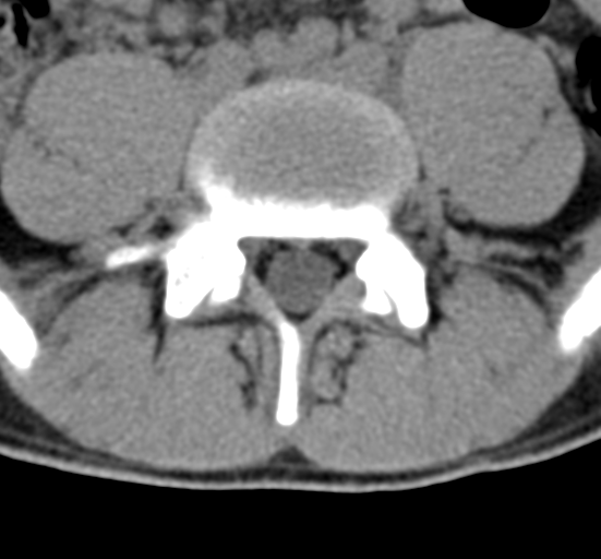 Clear cell meningoma - lumbar spine (Radiopaedia 60116-67691 Axial non-contrast 57).png