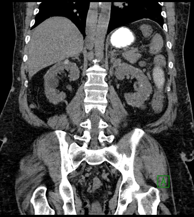 Closed-loop small bowel obstruction-internal hernia (Radiopaedia 78439-91096 Coronal non-contrast 69).jpg