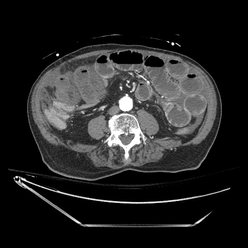 File:Closed loop obstruction due to adhesive band, resulting in small bowel ischemia and resection (Radiopaedia 83835-99023 B 88).jpg