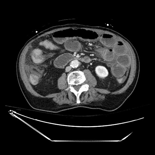 File:Closed loop obstruction due to adhesive band, resulting in small bowel ischemia and resection (Radiopaedia 83835-99023 D 80).jpg