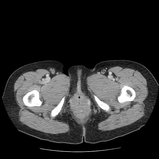 File:Closed loop small bowel obstruction (Radiopaedia 65403-74451 Axial 82).jpg