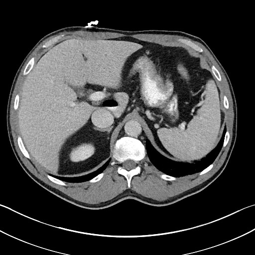 File:Closed loop small bowel obstruction - internal hernia (Radiopaedia 57806-64778 B 30).jpg