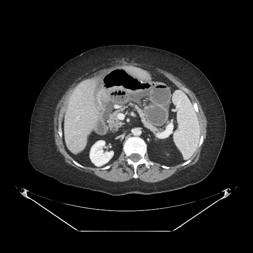 Closed loop small bowel obstruction - internal hernia (Radiopaedia 65402-74450 A 43).jpg