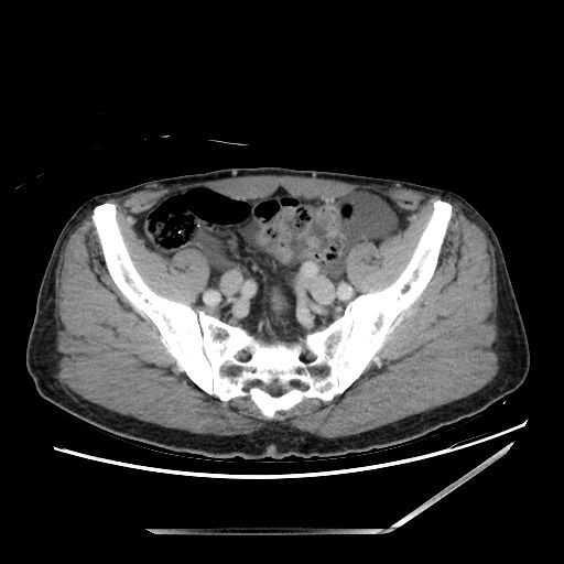 Closed loop small bowel obstruction - omental adhesion causing "internal hernia" (Radiopaedia 85129-100682 A 133).jpg