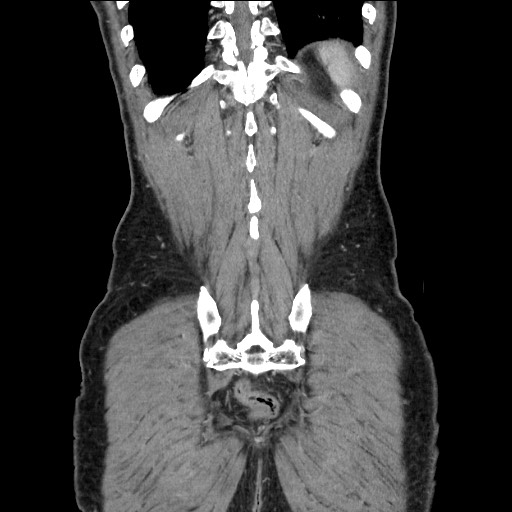 Closed loop small bowel obstruction - omental adhesion causing "internal hernia" (Radiopaedia 85129-100682 B 111).jpg